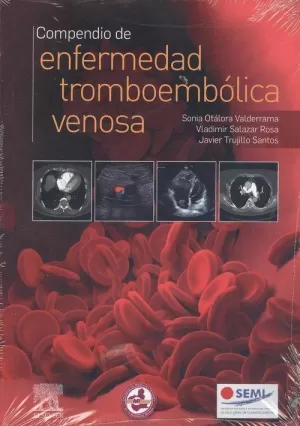 Compendio de Enfermedad Tromboembolica Venosa